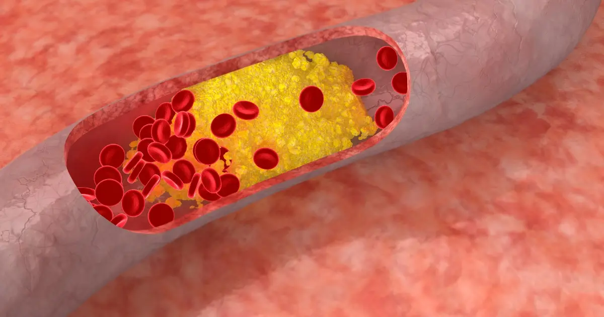 How Dangerous Is a 4 cm Aortic Aneurysm? Slowing PAD Progression