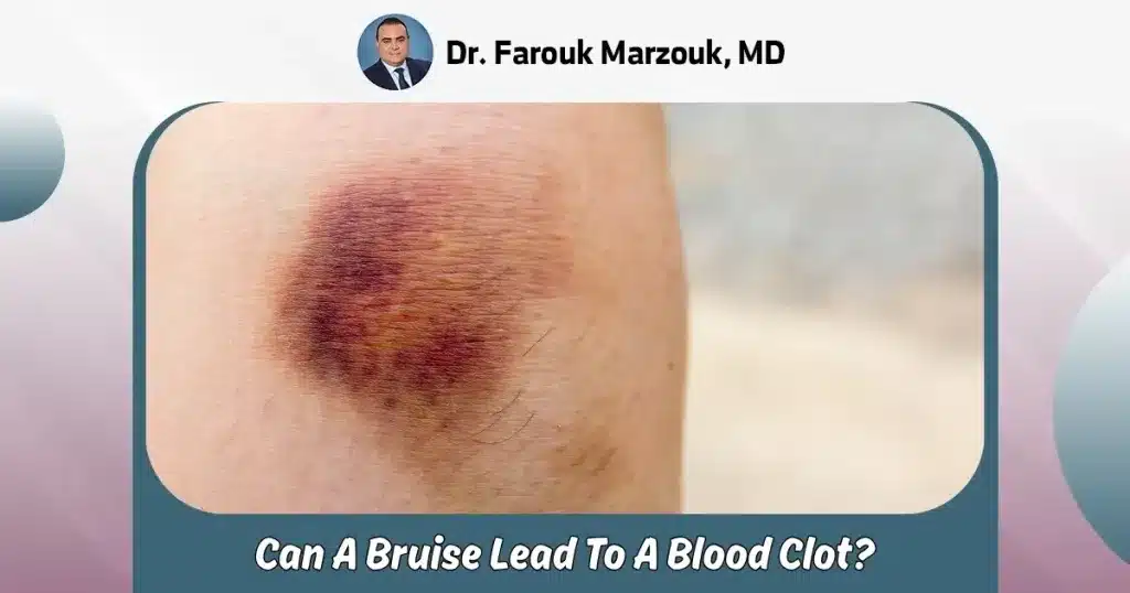 can a bruise lead to a blood clot