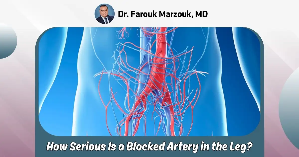 How Serious Is A Blocked Artery In The Leg: Is It Dangerous?