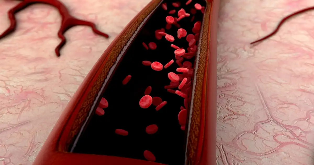 How Is A Blocked Artery In The Leg Treated?