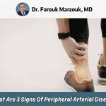 What Are 3 Signs Of Peripheral Arterial Disease
