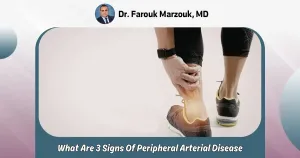 What Are 3 Signs Of Peripheral Arterial Disease