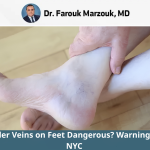 Are Spider Veins on Feet Dangerous? Warning Signs | NYC