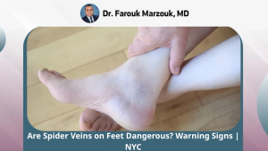 Are spider veins on feet dangerous?