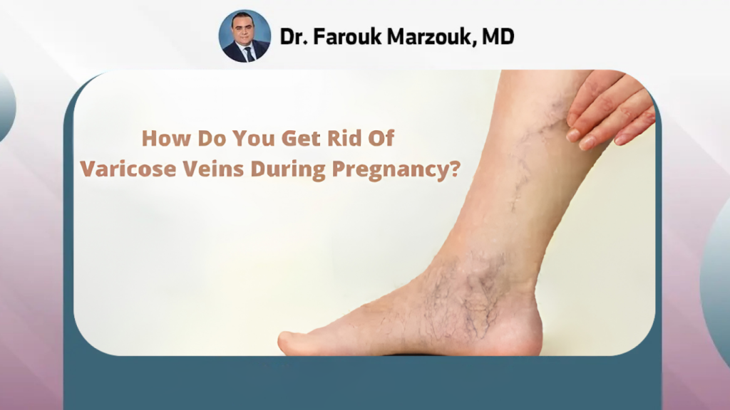 treatment of varicose veins during pregnancy