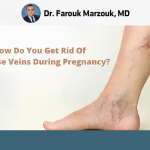 treatment of varicose veins during pregnancy
